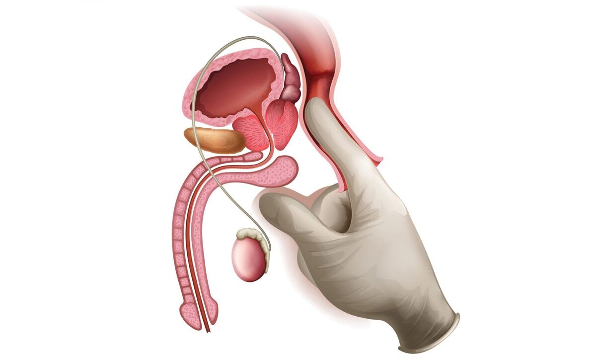 Massage de la prostate pour la prostatite