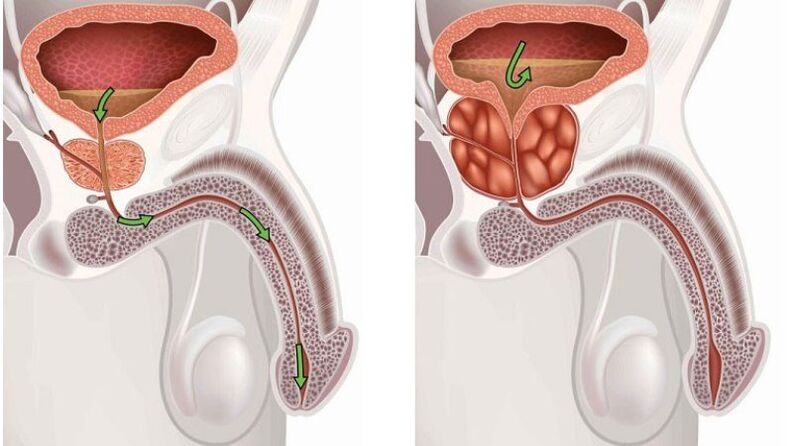 prostate saine et enflammée avec prostatite