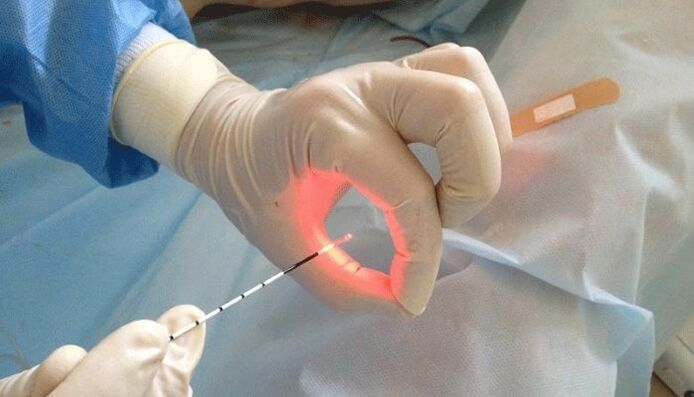 Traitement au laser pour la prostatite